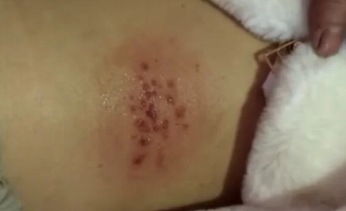 疱疹病毒一旦感染终身携带吗（疱疹病毒感染了以后一辈子都好不了吗）