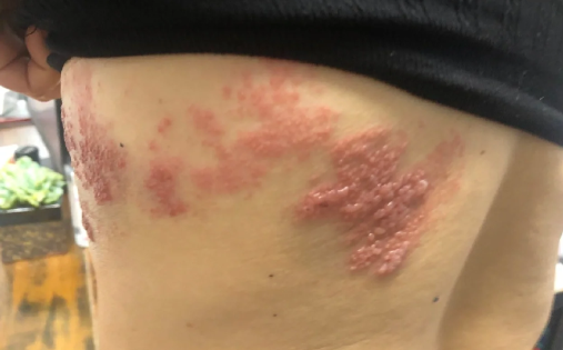 带状疱疹有时会被误认是皮炎吗（带状疱疹有时会被误认是皮炎吗）