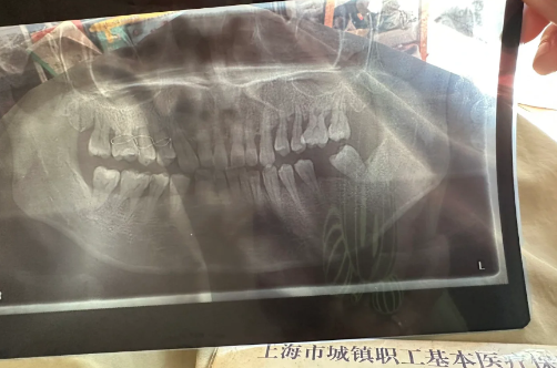 全口牙周刮治多少钱一次2023（牙周刮治可以一次性全口刮治吗）