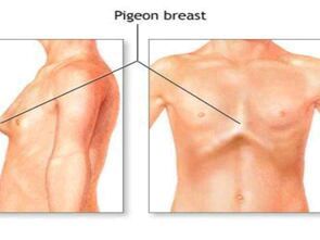 鸡胸是什么样的图片（鸡胸和正常人区别）