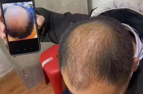 魔术丝能治秃顶吗（魔术丝能生发吗有效果吗）
